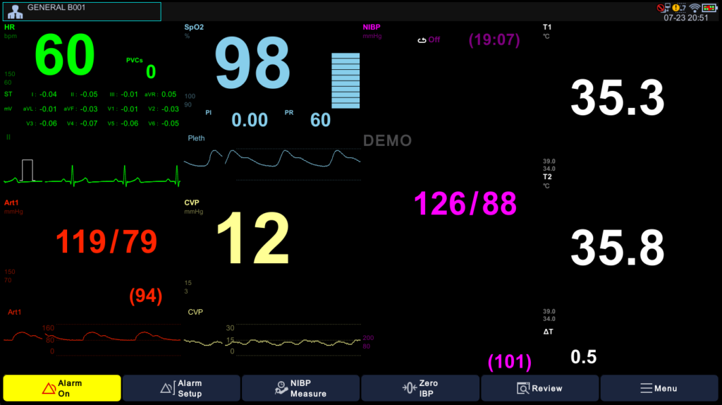 Large Font Display — Bedside at-a-glance view Brio X70 large font display mode showing oversized vital signs (HR 60, SpO2 98, NIBP 126/88, T1 35.3, T2 35.8, Art1 119/79, CVP 12) optimized for bedside at-a-glance visibility