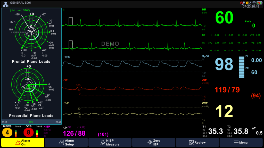 ST-Map — Frontal and Precordial plane leads with MEWS/GCS scoring Brio X50 display with ST-Map showing frontal and precordial lead maps alongside MEWS and GCS scoring and live waveforms