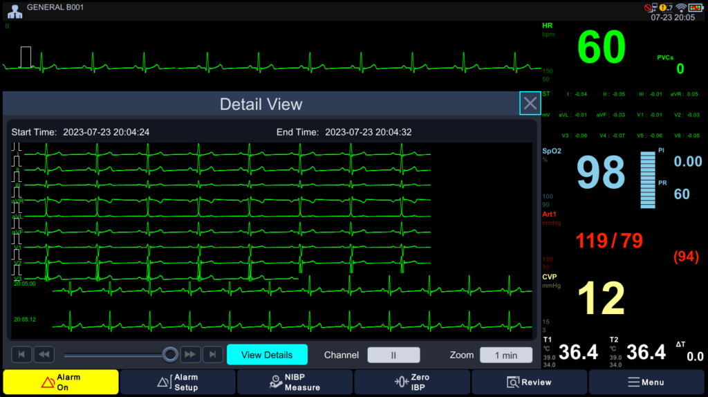 ECG Detail View — 12-lead Full Disclosure Brio X30 ECG detail view with 12-lead full disclosure waveforms for arrhythmia review