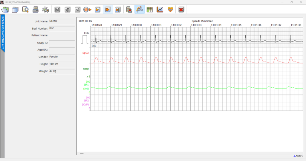 bm-central-pro-bmreview-multi-parameter-trend-screen BM Central Pro BMReview multi-parameter trend screen showing synchronized ECG, SpO2, and respiration waveforms across an extended time window