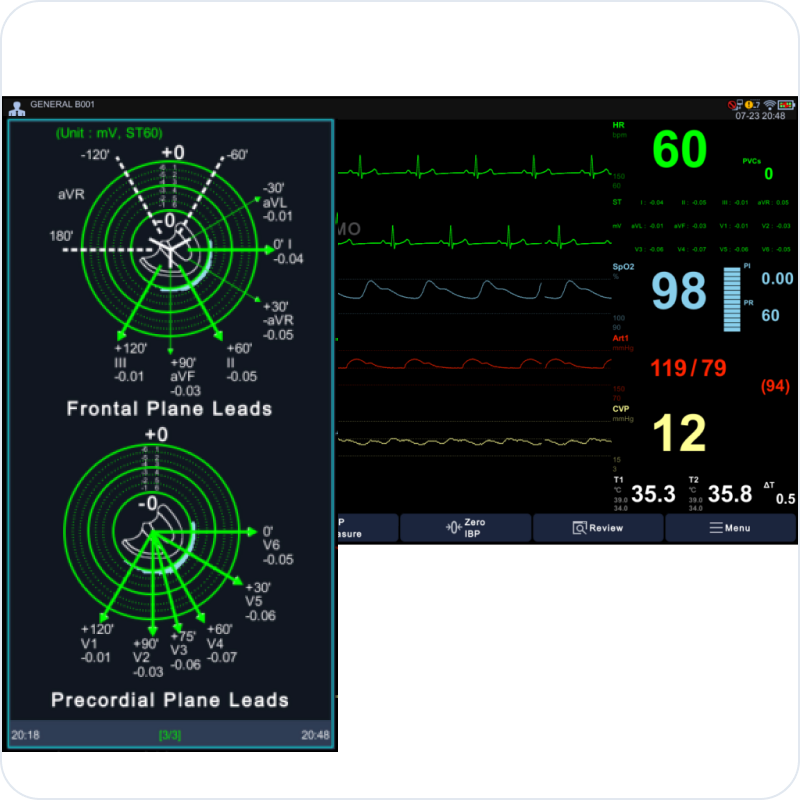 Bionet Brio X30 patient monitor — Bionet patented ST-Map display (design sample)