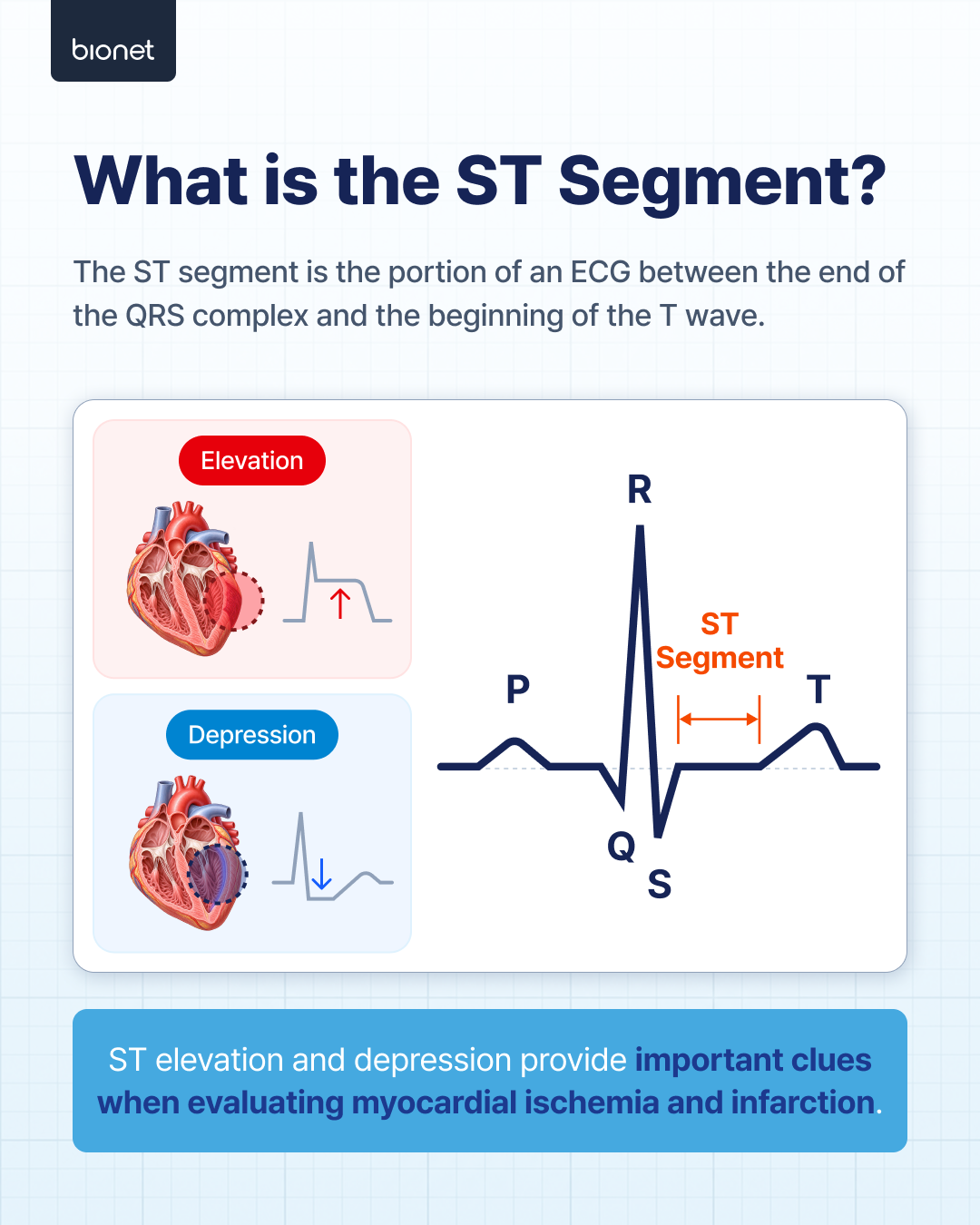 Diagram of the ST segment on an ECG waveform, showing ST elevation and ST depression.