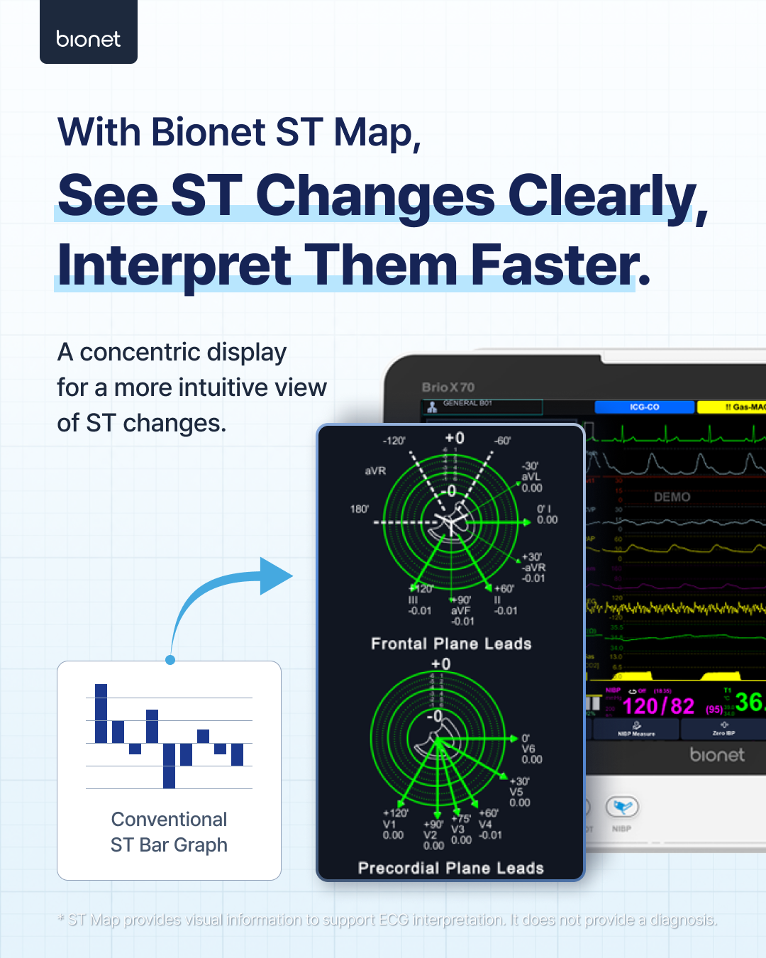 Bionet ST Map concentric display compared with a conventional ST bar graph.