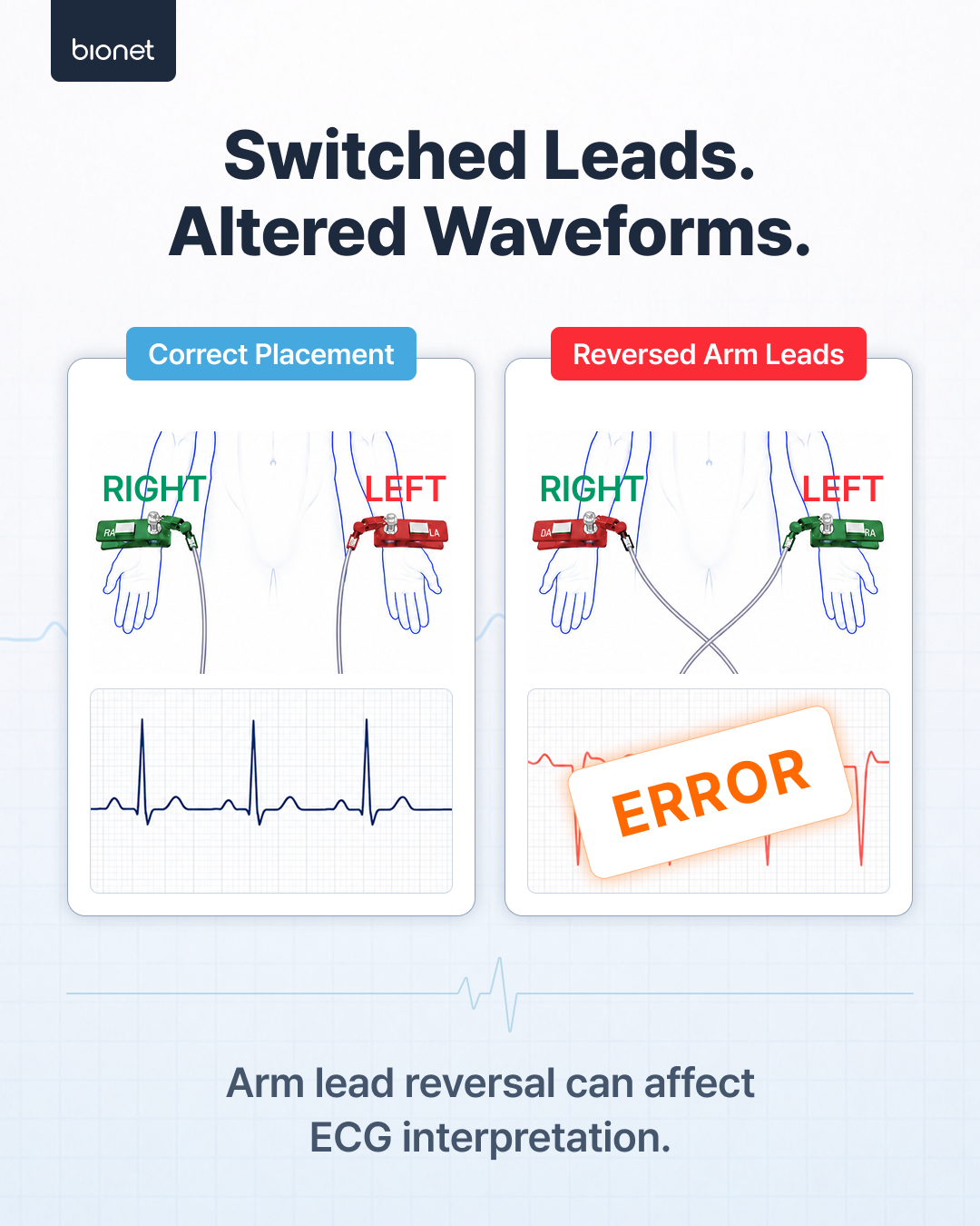 Correct placement versus reversed arm leads, and how arm lead reversal alters the recorded ECG waveform.