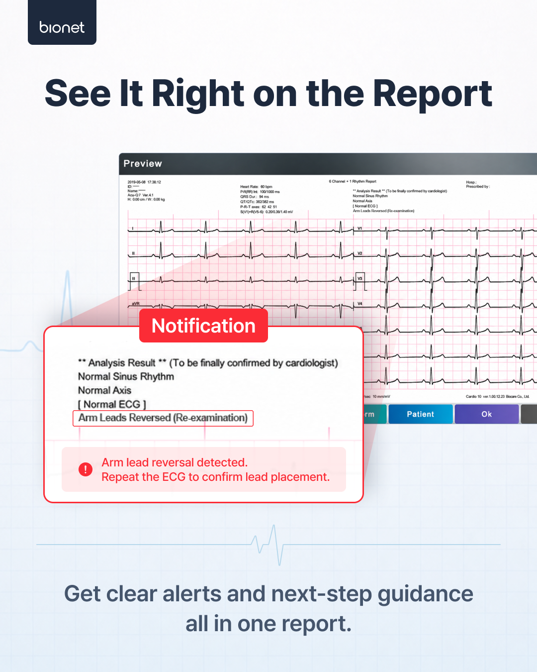 An ECG report showing the Arm Leads Reversed (Re-examination) notification, prompting the user to repeat the recording.